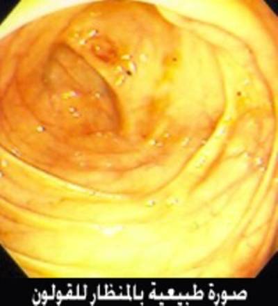 ���� Crohn`s Disease